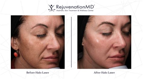 What To Expect From A Halo Laser Treatment Rejuvenationmd