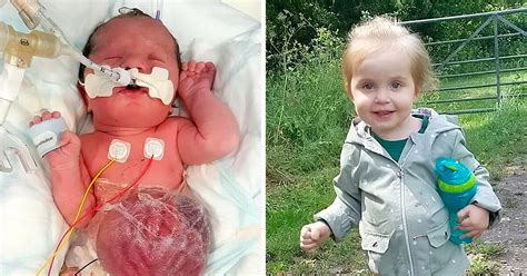 Girl Born With Vital Organs Outside Body Is Flourishing After Parents