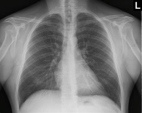 Hover on/off image to show/hide findings. healthy: Healthy Lungs Xray