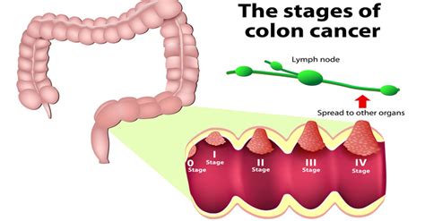 What are the signs and symptoms of colorectal cancer? 10 Warning Signs Of Colon Cancer You Shouldn't Ignore ...