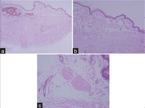 Primary Localized Cutaneous Nodular Amyloidosis With Bullous Lesions