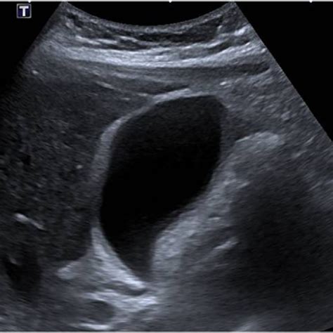 Long Axis Ultrasound View Of The Gallbladder Demonstrating A Thickened