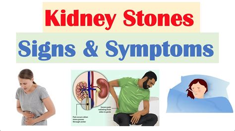 Kidney Stones Nephrolithiasis Signs And Symptoms And Why They Occur