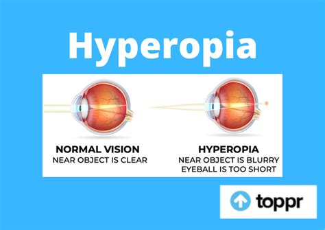 Hyperopia Introduction Causes Types And Symptoms