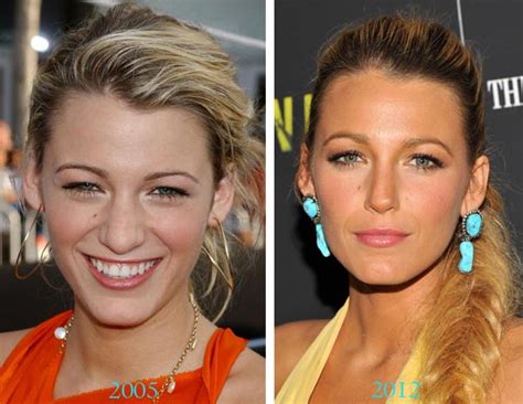 Blake Lively Nose Job Breast Implants Plastic Surgery Before After