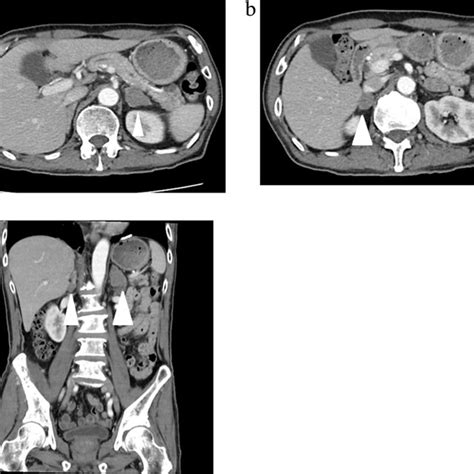 A Computed Tomography Ct Scans Showing Metastases In The Left