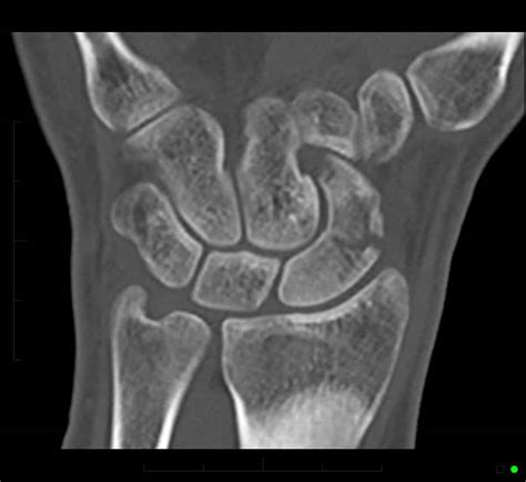 Wrist Mri Fracture