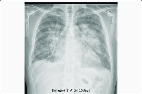 A X Ray Chest Frontal Projection Bilateral Perihilar Airspace