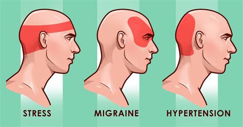Stop A Headache Without Any Pills Headache Remedies Migraine