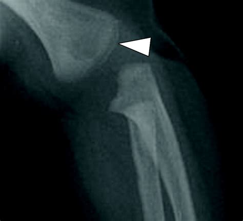 Distal Humeral Epiphyseal Separation In Young Children An Often Missed