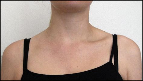 Transient Unilateral Neck Swelling After Unusual Exertion The
