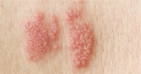 10 Home Remedies For Shingles Facty Health