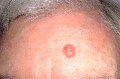Basal Cell Carcinoma Rodent Ulcer On The Cheek Also S