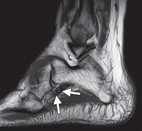 High Resolution Us And Mr Imaging Of Peroneal Tendon Injuries