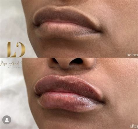 Dermal Fillers In Philadelphia Pa Lips And Drips By Erica