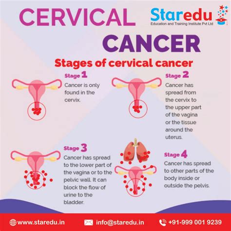 Cervical Cancer Stages