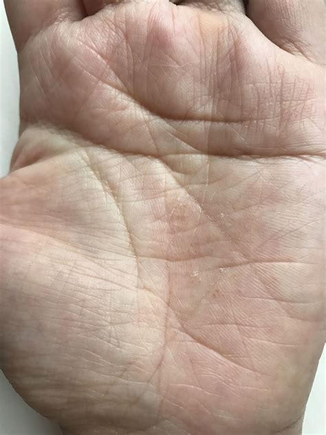 Blisters Are Commonly Found In Dyshidrotic Eczema Seen Here Are Blisters On The Palms The