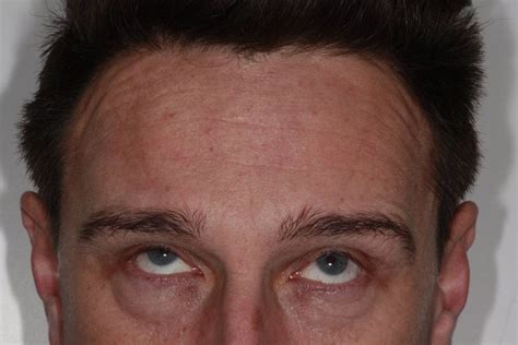 Forehead After Parrock Dental And Implant Centres