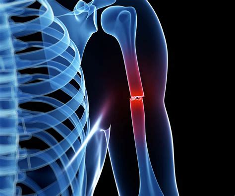 Fractures And Broken Bones Golden State Orthopedics And Spine