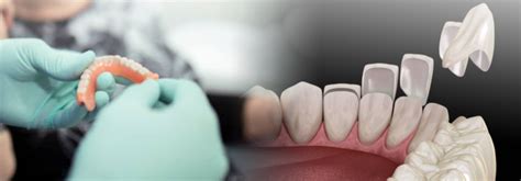 Comparing The Differences Between Dentures And Veneers Teeth First