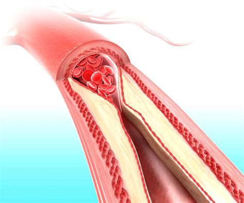 How To Clean Your Arteries With One Simple Fruit True Activist