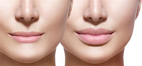 Atlanta Ga Lip Filler Treatment Buckhead Facial Plastic Surgeon