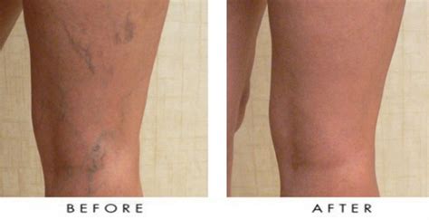 Thread Vein Removal Aesthetic Cosmetic Clinic Ltd