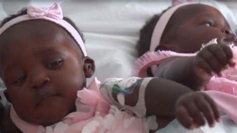 Conjoined Twins Separated After 16 Hour Surgery Nigerian News Latest