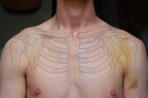 How To Rehab A Collarbone After Surgery