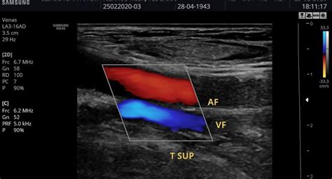 Ultrasonido Doppler Arterial Venoso Dr Emmanuel Acu A