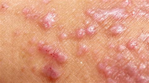 Atopic Dermatitis Eczema Symptoms Icd Treatment Atopic Free Download Nude Photo Gallery
