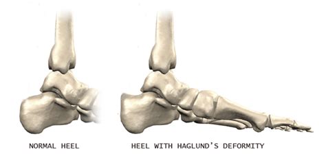 Haglunds Deformity 🩺singapore Sports And Orthopaedic Surgeon