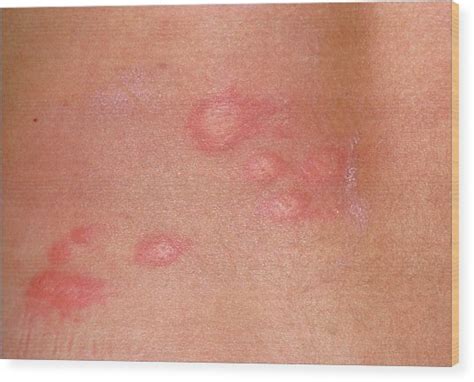 Urticaria Skin Rash Of The Back Of A Patient Photograph By Dr P