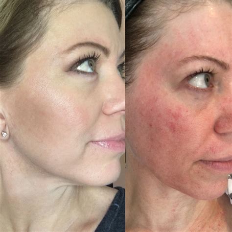 List Pictures Microneedling Pictures Before And After Excellent