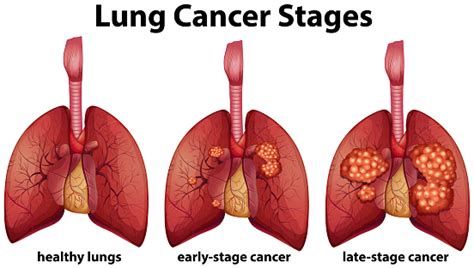 Diagram Showing Lung Cancer Stages Stock Illustration Download Image
