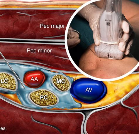 Ultrasound Guided Infraclavicular Brachial Plexus Block Nysora