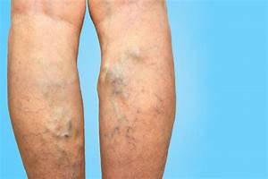 Two Common Risk Factors for Spider Veins and Varicose Veins: Prime Heart and Vascular ...  Heart and Circulation Varicose Veins