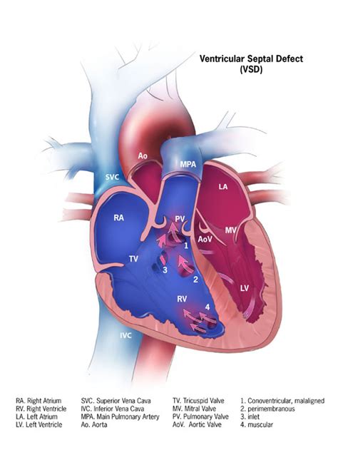 The Blue Baby Syndrome Introduction And Management Of The Tetralogy Of
