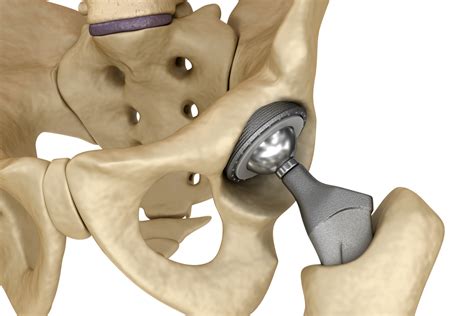 A wide variety of hip augmentation options are. Hip Implants: Complications from Metal-on-Metal Replacements