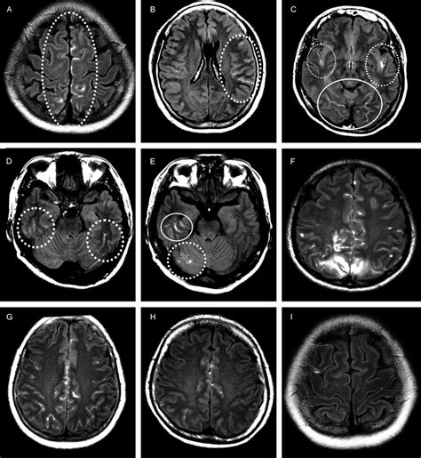 Patterns Of Blood Brain Barrier Bbb Breakdown In Patients With