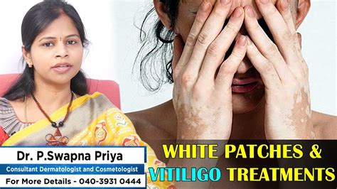 Advanced Treatments For Vitiligo Leucoderma White Spots And