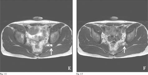 Figure 1 From Entrapment Neuropathy Of The Sciatic Nerve Caused By A