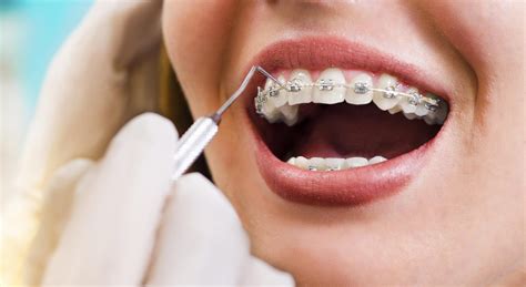Orthodontic treatment increases in popularity amongst adults ...
