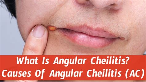 What Is Angular Cheilitis Causes Of Angular Cheilitis Ac Youtube