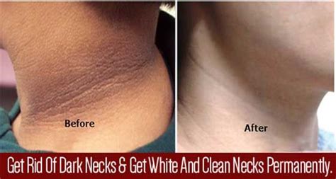 Dark Patches Usually Appear On The Neck Armpits And Inner Thighs Due