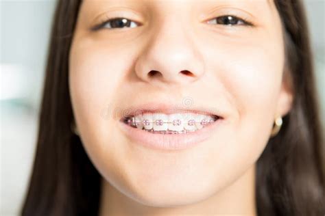 Closeup Of Smiling Teenage Girl With Braces Stock Image Image Of