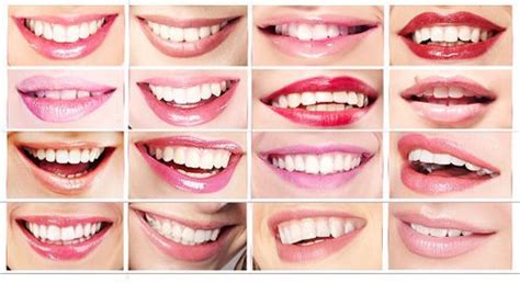 The Three Types Of Smiles West Palm Beach Dentist