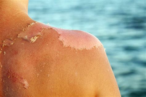 How To Get Rid Of Peeling Skin Gently And Effectively