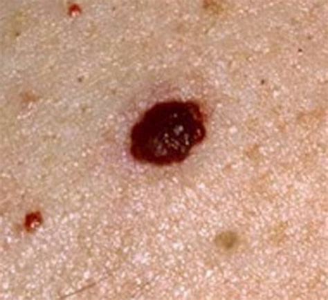 Cherry Angioma Causes Pictures Diagnosis Treatment And Removal
