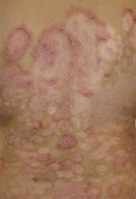 Bullous Drug Eruption In A Patient With Psoriasis After A Test Dose Of